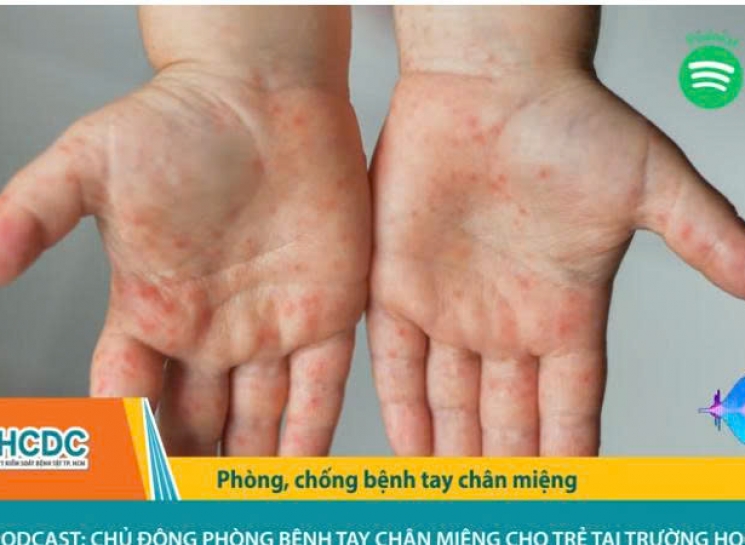 Chủ động phòng bệnh tay chân miệng cho trẻ tại trường học